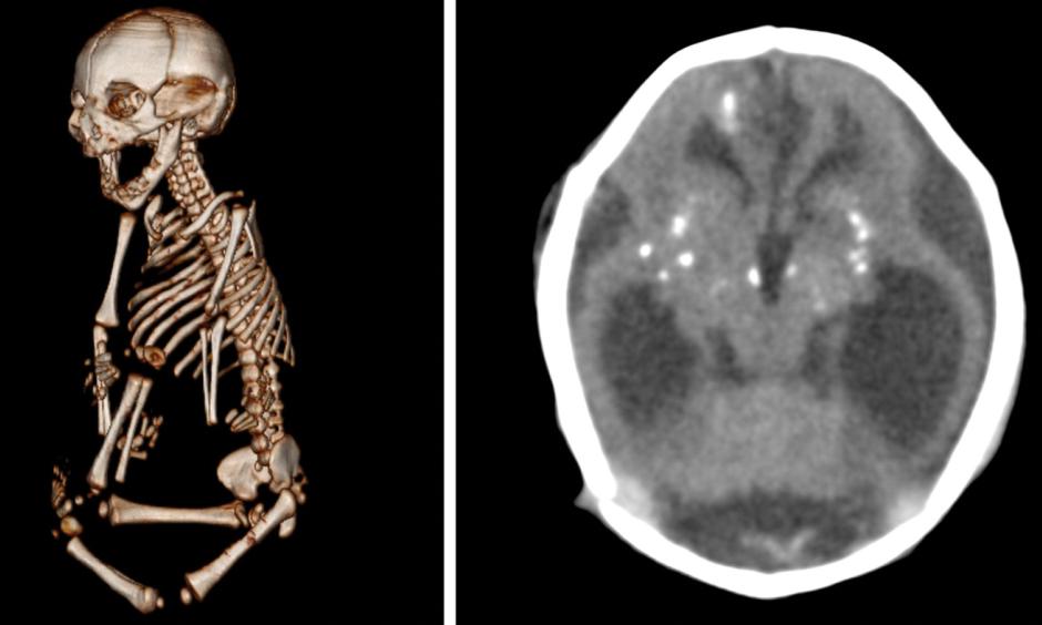 Zika infections during gestation can damage other parts of the body besides the brain. In this case, the baby was born with severe stiffness in the joints, which keeps the baby from straightening arms and legs normally. The baby's brain shows the telltale sign of an infection: white dots called calcification. Image: Radiological Society of North America