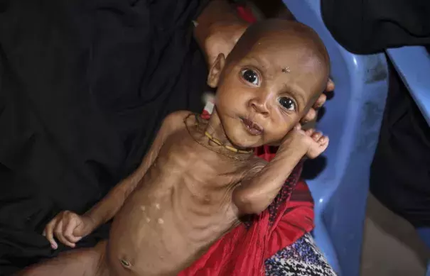 In this photo taken Saturday, Feb. 25, 2017, malnourished baby Ali Hassan, 9-months-old, is held by his mother Fadumo Abdi Ibrahim, who fled the drought in southern Somalia, at a feeding center in a camp in Mogadishu, Somalia. Photo: Fara Abdi Warsameh, Associated Press