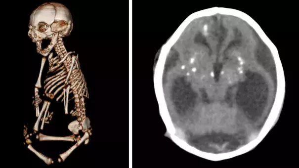 Zika infections during gestation can damage other parts of the body besides the brain. In this case, the baby was born with severe stiffness in the joints, which keeps the baby from straightening arms and legs normally. The baby's brain shows the telltale sign of an infection: white dots called calcification. Image: Radiological Society of North America